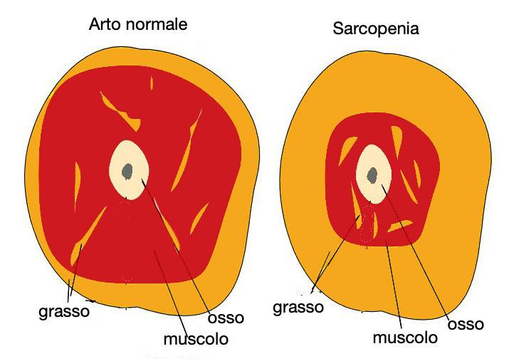 sarcopenia - AGING Project