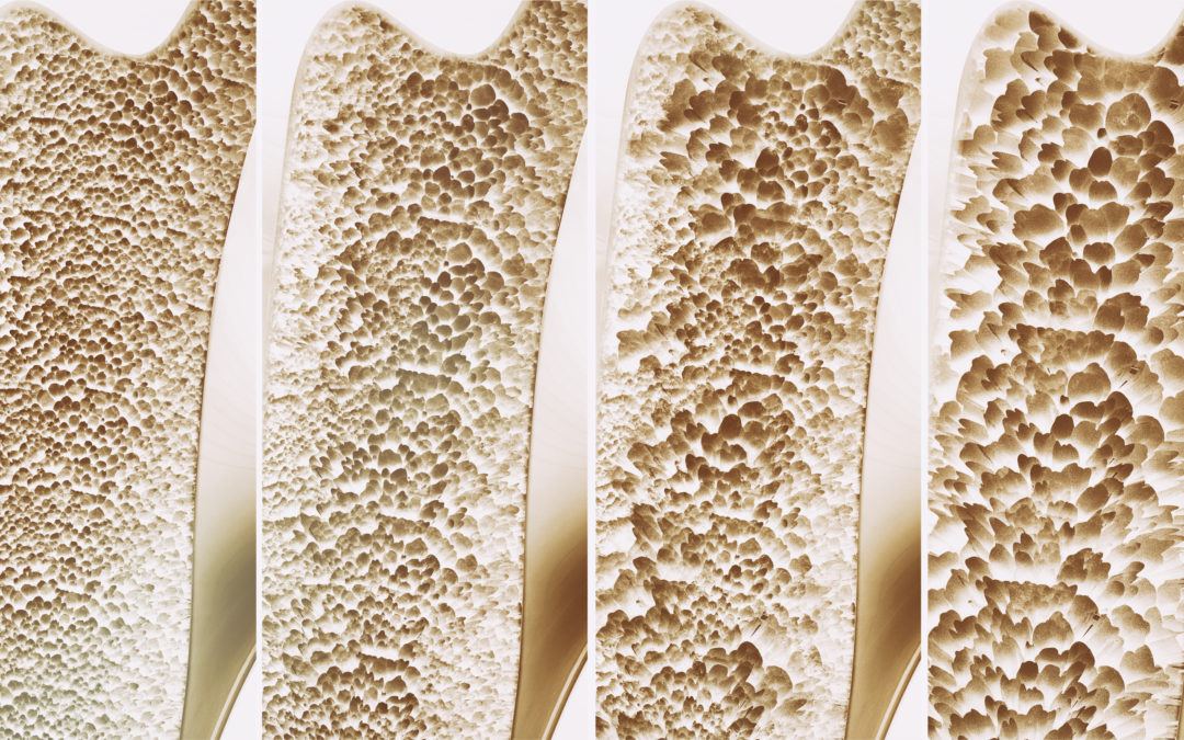 Postmenopausal Osteoporosis: 10 Years of Denosumab treatment results