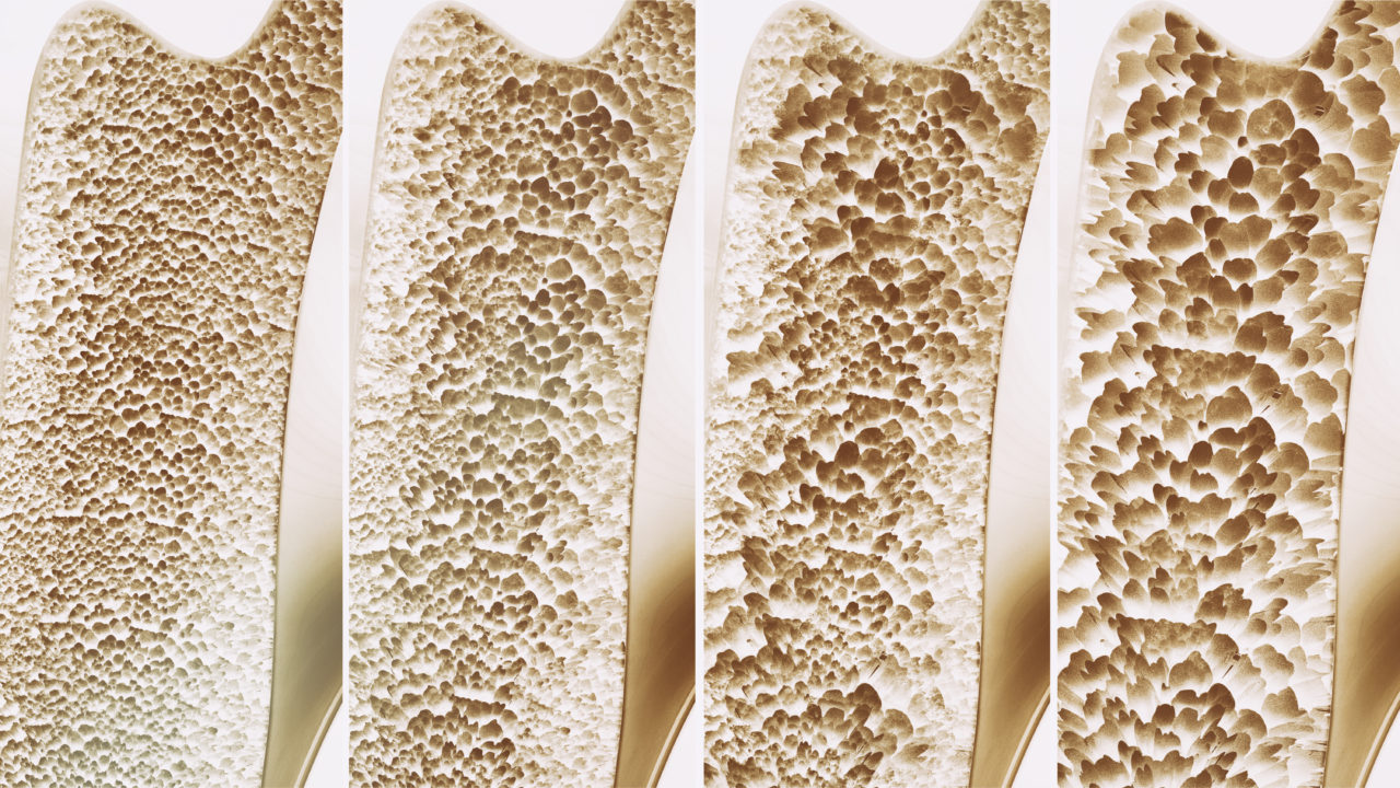 osteoporosis treatment - Aging Project