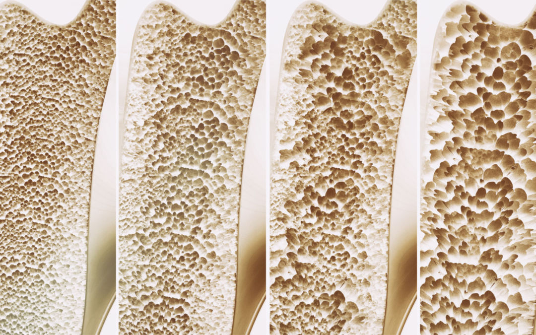 Osteoporosi: i benefici dell’attività fisica valutati attraverso i biomarker