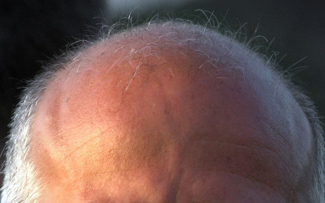 Alopecia androgenetica: perdere i capelli ma non l’autostima