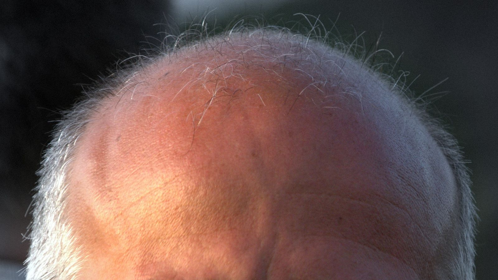 Alopecia androgenetica