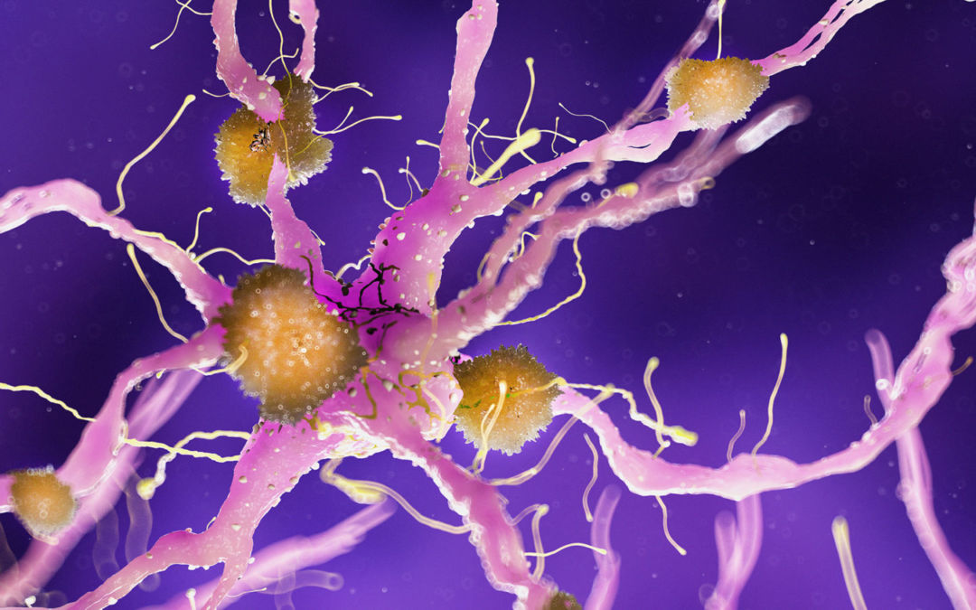 Aducanumab per la cura della malattia di Alzheimer: luci e ombre
