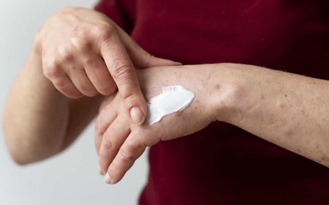 I Probiotici fanno bene alla pelle? Parte 1: la psoriasi