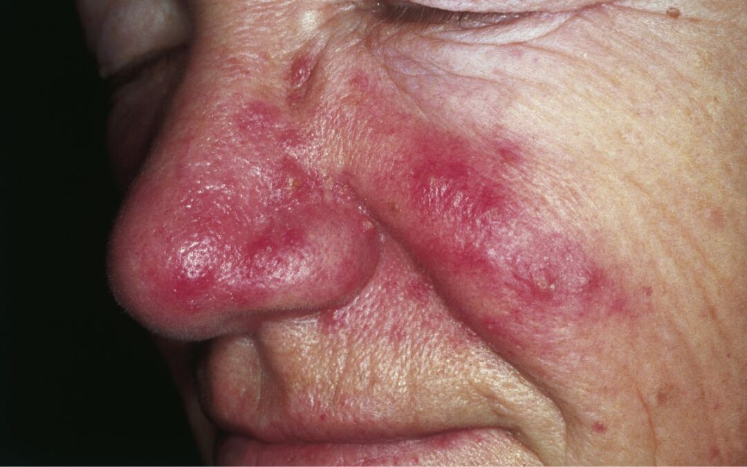 rosacea