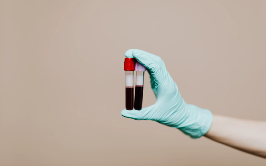 Esami ematici per misurare i libelli di lipoproteina(a) e Lp(a)
